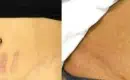 thumbs_1_before-and-after-treatment-with-lasers-to-reduce-stretch-marks