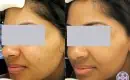 thumbs_2_mild-acne-laser-treatment