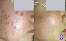 thumbs_acne-removal-cheek