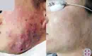 thumbs_acne-treatment-before-and-after-4