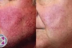 thumbs_before-and-after-laser-treatment-for-rosacea