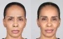 thumbs_botox-cosmetic-injections-female