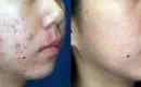 thumbs_cystic-acne-treatment-with-lasers-before-after