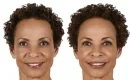 thumbs_juvederm-filler-patient-before-and-after-results-female-3-copy