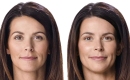 thumbs_juvederm-filler-patient-before-and-after-results-female-5-copy