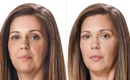thumbs_juvederm-filler-patient-before-and-after-results-female-6-copy