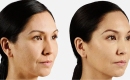 thumbs_juvederm-filler-patient-before-and-after-results-female-copy