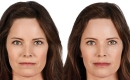 thumbs_juvederm-filler-patient-before-and-after-results-female2-copy