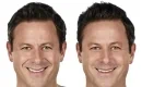 thumbs_juvederm-filler-patient-before-and-after-results-male-copy