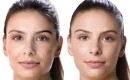 thumbs_juvederm-filler-results-patient-before-and-after-treatment-female-8-copy