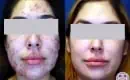 thumbs_laser-acne-treatment-before-and-after-results-2
