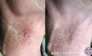 thumbs_laser-spider-vein-removal-neck-male-before-and-after