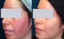 thumbs_laser-treatment-for-rosacea-before-and-after