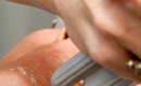 thumbs_laser-vein-removal-veins-on-face
