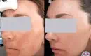 thumbs_melasma-removal-from-face