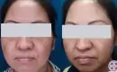 thumbs_melasma-treatment-before-and-after-8