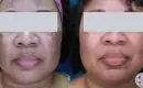 thumbs_melasma-treatment-before-and-after-9