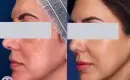 thumbs_melasma-treatment-before-and-after