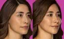 thumbs_restylane-before-and-after-filler-7