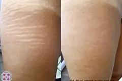 thumbs_stretch-mark-removal-before-after-2