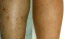thumbs_sun-spots-on-legs-removed-with-laser-treatment-before-and-after