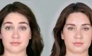 thumbs_young-female-before-and-after-botox-cosmetic