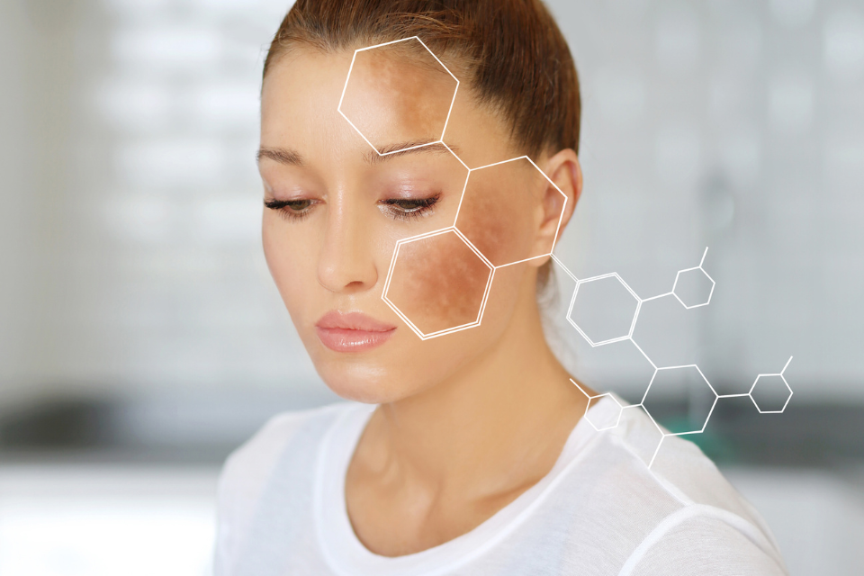 Close-up of a woman experiencing facial melasma and hyperpigmentation, with a white scientific molecular overlay illustrating targeted skin treatment.