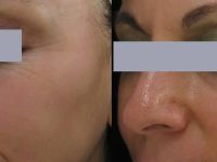 1-collagen-induction-therapy-before-after-1