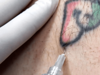 1-injections-fmake-laser-tattoo-removal-completely-painless