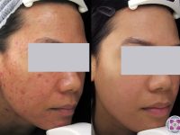 1_acne-removal-asian-skin