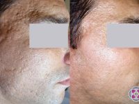 1_acne-scar-reduction