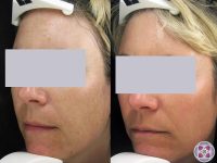 1_agespot-removal-before-after-laser-treatment