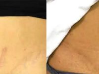 1_before-and-after-treatment-with-lasers-to-reduce-stretch-marks