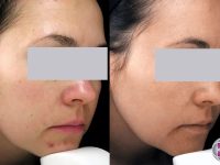 1_dark-spots-removal