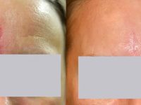 1_scar-removal-laser-treatment-before-and-after