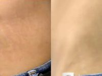 1_stretch-mark-removal-on-man-love-handles-with-lasers
