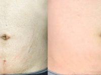 1_stretch-mark-removal-on-man-with-lasers