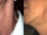 2-microneedling-before-after-1
