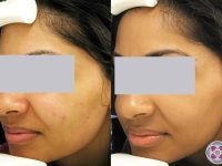 2_mild-acne-laser-treatment