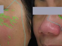 3-collagen-induction-therapy-before-after-3