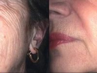 4-microneedling-before-after-2