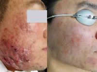 AcneBeforeAndAfter03