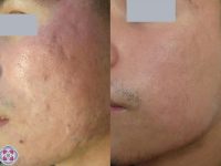 AcneScarBeforeandAfter01