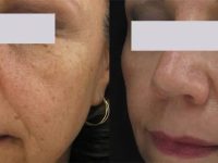 Age Spots Before and After