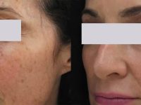 AgeSpotsBeforeandAfter02