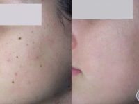 Age Spots Before and After