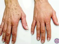 AgeSpotsBeforeandAfter05