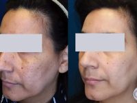Age spot removal before and after