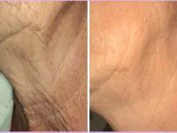 BandA_SkinTightening5