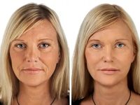 DermalFillers01
